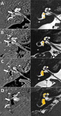Endolymphatic Hydrops in Fluctuating Hearing Loss and Recurrent Vertigo